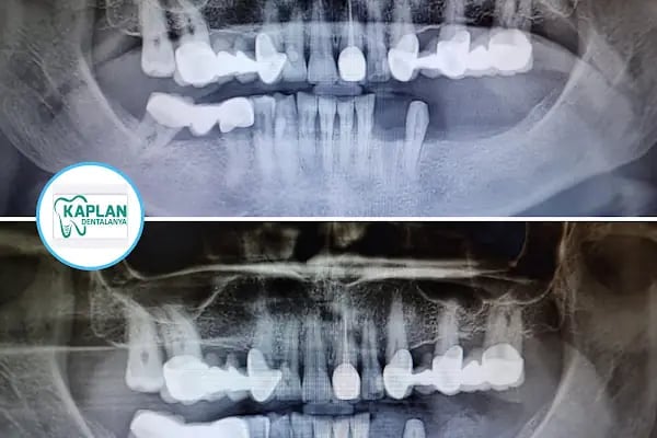 Kaplan DentAlanya Ağız ve Diş Sağlığı Polikliniği - Resim 18