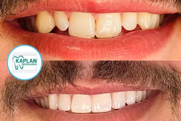 Kaplan DentAlanya Ağız ve Diş Sağlığı Polikliniği - Resim 19