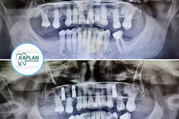 Kaplan DentAlanya Ağız ve Diş Sağlığı Polikliniği - Resim 17
