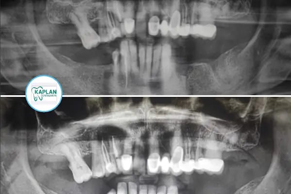Kaplan DentAlanya Ağız ve Diş Sağlığı Polikliniği - Resim 20