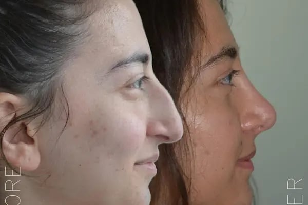 Op. Dr. Muharrem Demiroğulları - Ankara Botoks, Dudak Dolgusu, Liposuction, Burun Estetiği, Meme Büyütme, Göz Kapağı Estetiği, Lazer Epilasyon - Resim 3
