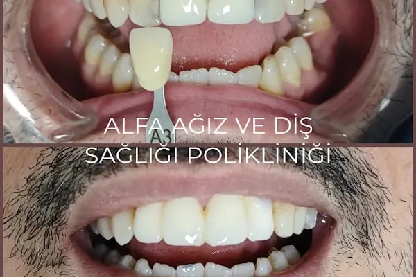 Alfa Ağız ve Diş Sağlığı Polikliniği - Resim 15