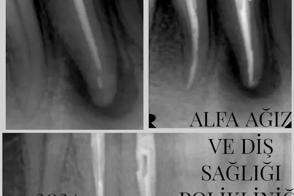 Alfa Ağız ve Diş Sağlığı Polikliniği - Resim 17