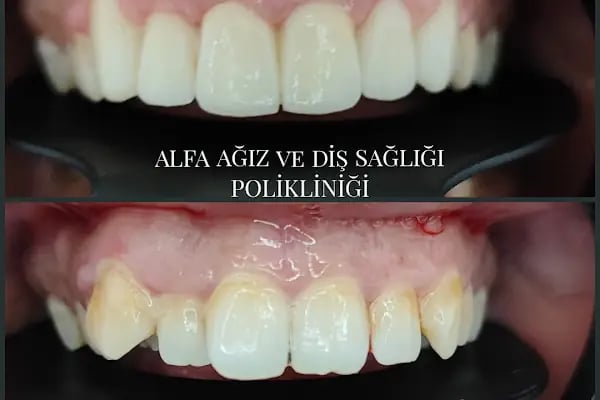 Alfa Ağız ve Diş Sağlığı Polikliniği - Resim 19