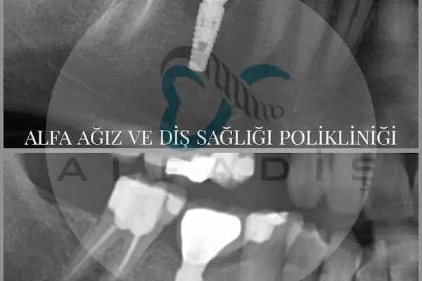 Alfa Ağız ve Diş Sağlığı Polikliniği - Resim 18