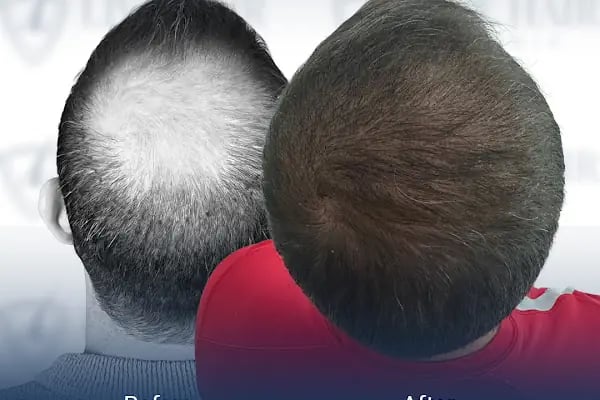 Live Hair Clinic - Resim 6