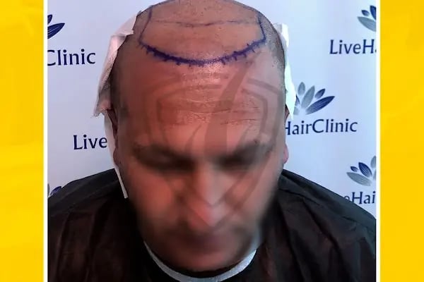 Live Hair Clinic - Resim 19