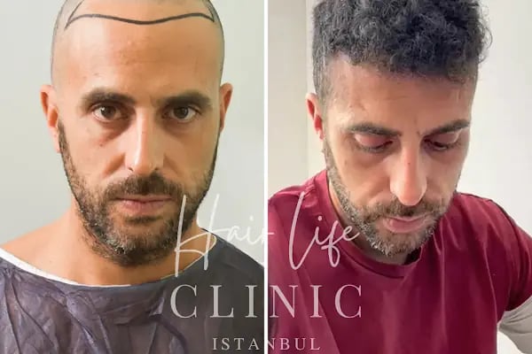 Hair Life Saç Ekim Merkezi - Resim 16