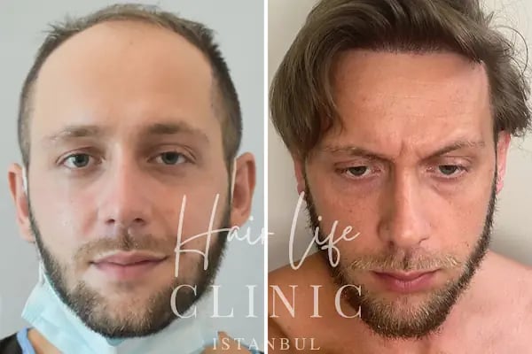 Hair Life Saç Ekim Merkezi - Resim 20