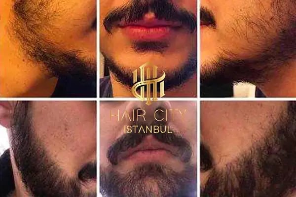 Hair City İstanbul Saç Ekimi - Resim 16