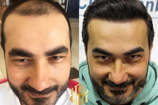 Hair City İstanbul Saç Ekimi - Resim 13