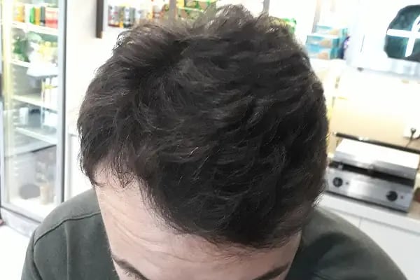 Hair City İstanbul Saç Ekimi - Resim 4