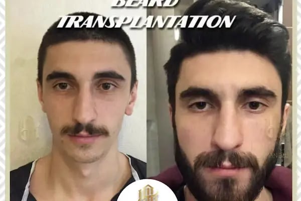 Hair City İstanbul Saç Ekimi - Resim 18