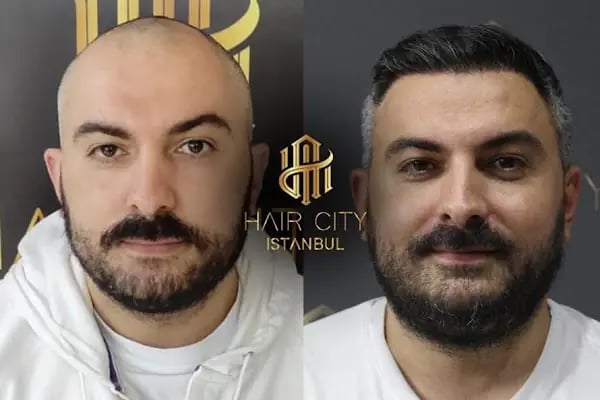 Hair City İstanbul Saç Ekimi - Resim 1