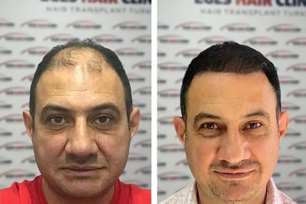 DR. BABACAN Medikal Estetik Saç Ekim&amp;Lazer Epilasyon&amp;Zayıflama - Resim 14