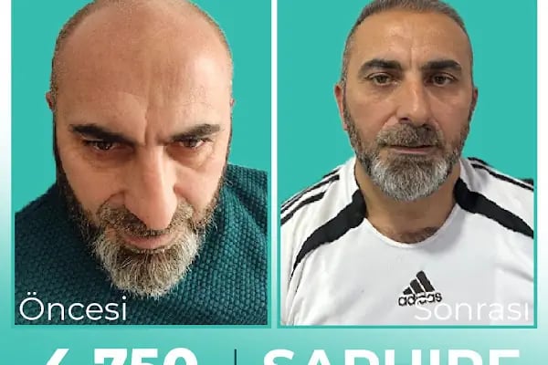 Carla Clinic Saç Ekim Merkezi Avcılar - Resim 10