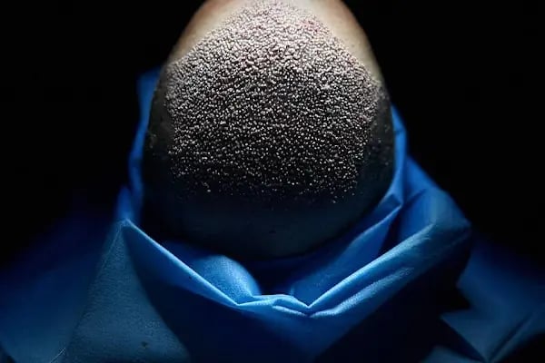 Carla Clinic Saç Ekim Merkezi Avcılar - Resim 3