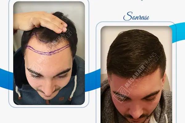 Mega Hair Trans Saç Ekim Merkezi İstanbul - Resim 7