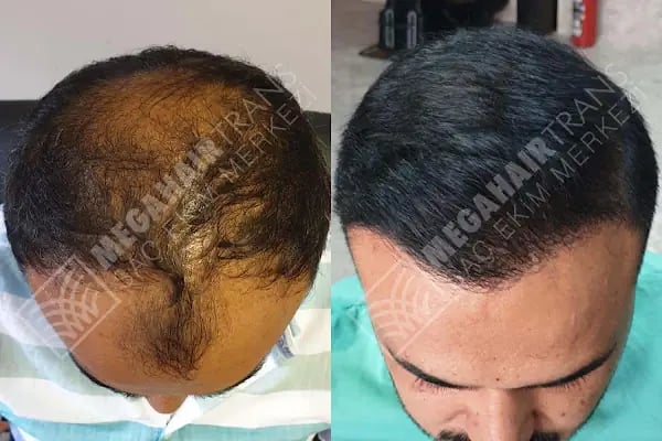 Mega Hair Trans Saç Ekim Merkezi İstanbul - Resim 20