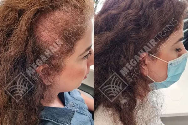 Mega Hair Trans Saç Ekim Merkezi İstanbul - Resim 10