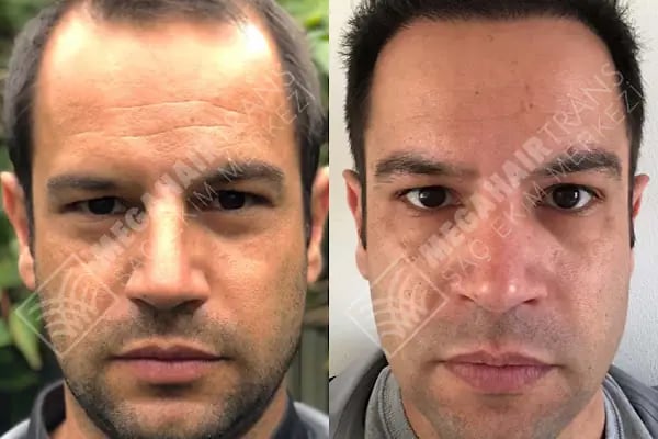Mega Hair Trans Saç Ekim Merkezi İstanbul - Resim 13