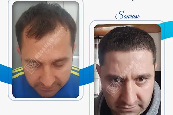 Mega Hair Trans Saç Ekim Merkezi İstanbul - Resim 11