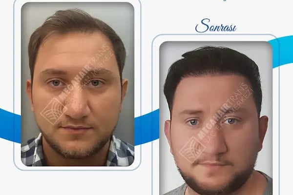 Mega Hair Trans Saç Ekim Merkezi İstanbul - Resim 4