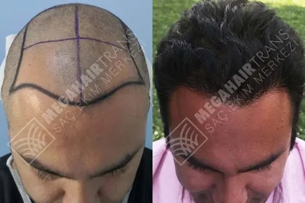 Mega Hair Trans Saç Ekim Merkezi İstanbul - Resim 18