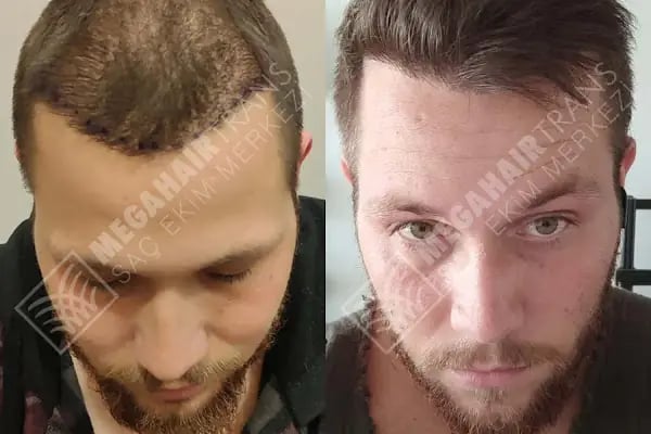 Mega Hair Trans Saç Ekim Merkezi İstanbul - Resim 12
