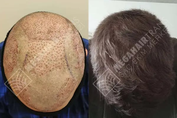 Mega Hair Trans Saç Ekim Merkezi İstanbul - Resim 19