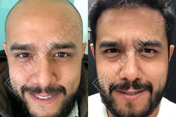 Mega Hair Trans Saç Ekim Merkezi İstanbul - Resim 8