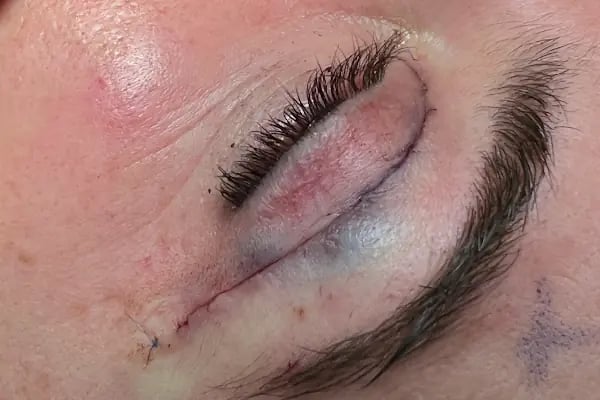Op. Dr. Ufuk ÜRDEM Göz Hastalıkları ve Cerrahisi Uzmanı. Lazer, Akıllı Lens, Göz Kapağı Estetiği, Şaşılık, Katarakt - Resim 6