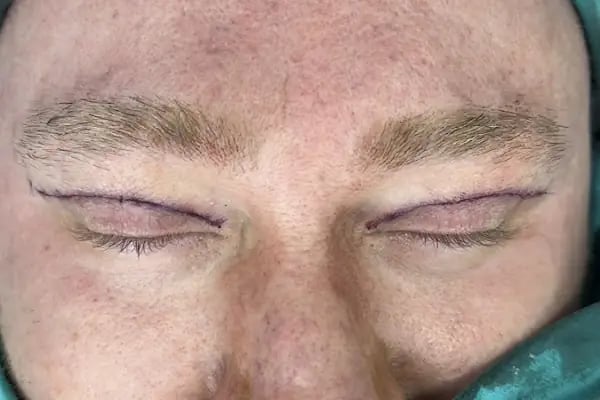 Op. Dr. Ufuk ÜRDEM Göz Hastalıkları ve Cerrahisi Uzmanı. Lazer, Akıllı Lens, Göz Kapağı Estetiği, Şaşılık, Katarakt - Resim 17