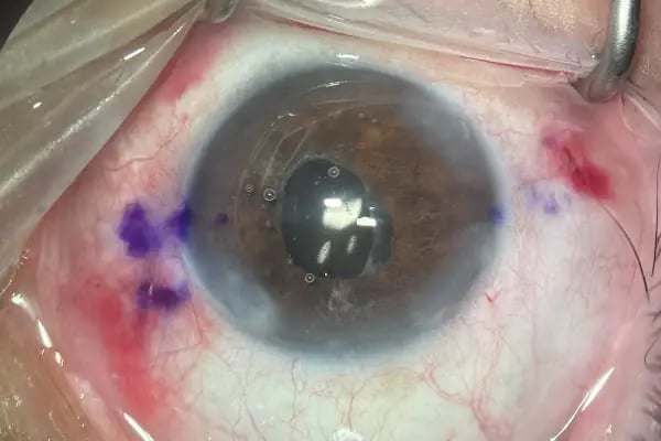 Op. Dr. Ufuk ÜRDEM Göz Hastalıkları ve Cerrahisi Uzmanı. Lazer, Akıllı Lens, Göz Kapağı Estetiği, Şaşılık, Katarakt - Resim 3