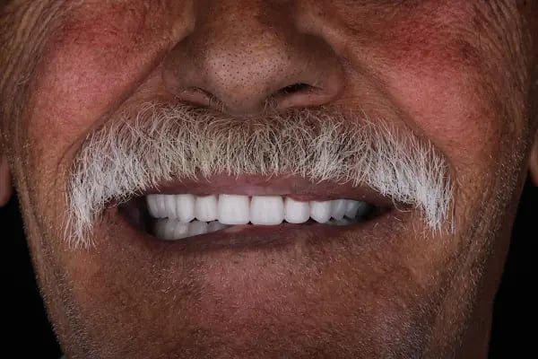 Dent Alkan (Bağlıca İmplant, Bağlıca Kanal Tedavisi, Bağlıca Zirkonyum Diş, Bağlıca Diş Kliğini, Bağlıca Diş Hekimi) - Resim 13