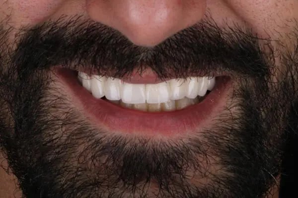 Dent Alkan (Bağlıca İmplant, Bağlıca Kanal Tedavisi, Bağlıca Zirkonyum Diş, Bağlıca Diş Kliğini, Bağlıca Diş Hekimi) - Resim 5