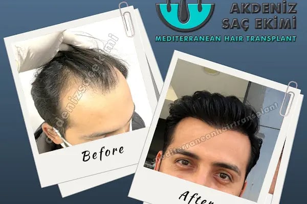Akdeniz Antalya Saç Ekimi - Hair Transplant Antalya - Resim 5