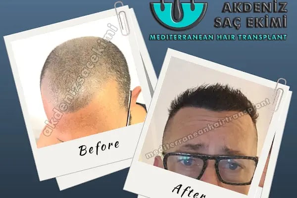 Akdeniz Antalya Saç Ekimi - Hair Transplant Antalya - Resim 6