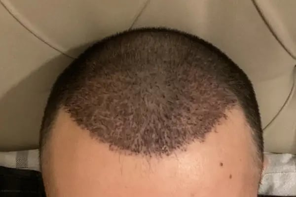 SE Hair Clinic | Hair Transplant Antalya - Resim 1