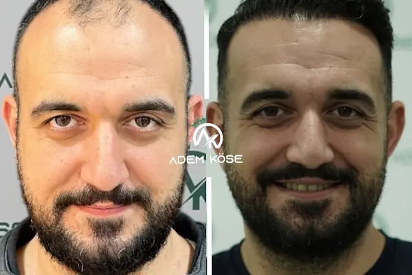 Adem Köse - Hair Transplant Turkey - Resim 2