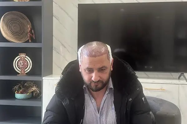 Adem Köse - Hair Transplant Turkey - Resim 11