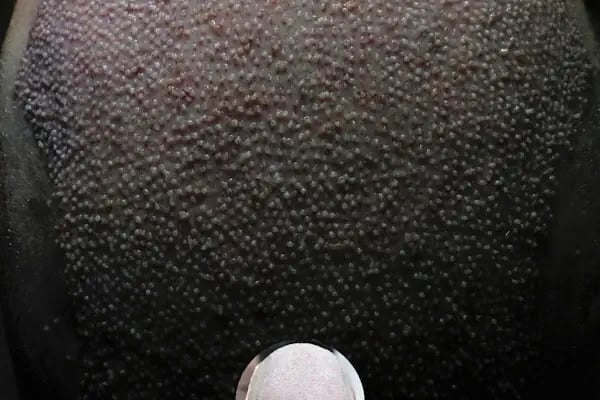 Adem Köse - Hair Transplant Turkey - Resim 6