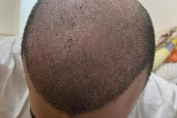 Adem Köse - Hair Transplant Turkey - Resim 9