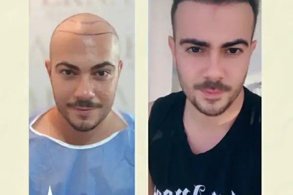Erna Hair Clinic İzmir Saç Ekim Merkezi - Resim 1
