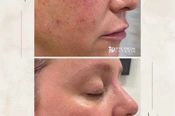 İpek Parsak Güzellik Merkezi - Diode Lazer Epilasyon - Hydrafacial Cilt Bakımı - Resim 16