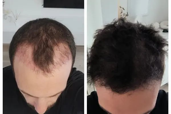 Lale Keskin Saç Ekim Merkezi - Resim 2