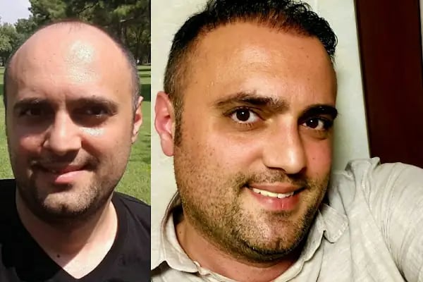 Emphair Hair Transplantation Premium Istanbul Clinic - Saç Ekimi - EMPCLINICS - Resim 17