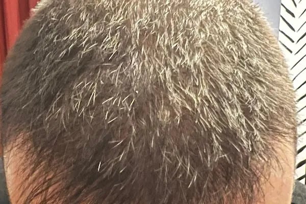Emphair Hair Transplantation Premium Istanbul Clinic - Saç Ekimi - EMPCLINICS - Resim 13
