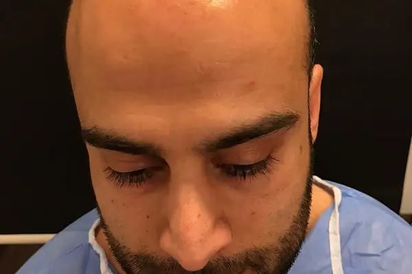 Emphair Hair Transplantation Premium Istanbul Clinic - Saç Ekimi - EMPCLINICS - Resim 19