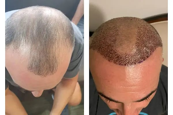 Emphair Hair Transplantation Premium Istanbul Clinic - Saç Ekimi - EMPCLINICS - Resim 15
